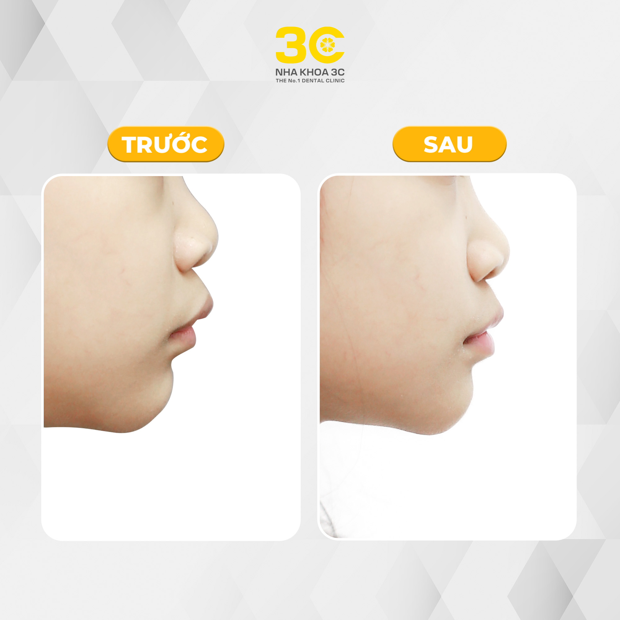 Lê Hoàng Thư Nhiên - Chỉnh nha bằng khí cụ EF