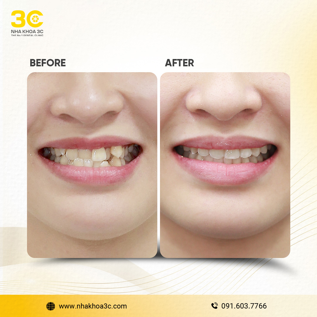 Orthodontics - Nha Khoa 3C