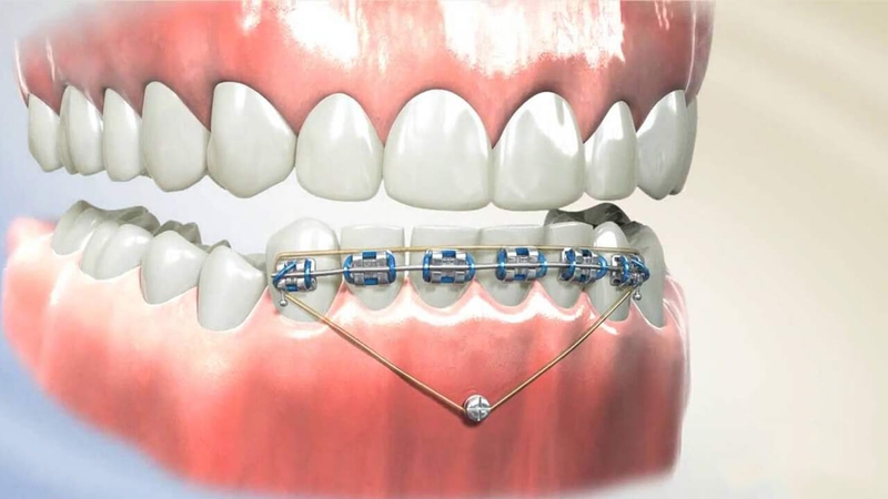 Bắt vít niềng răng là kĩ thuật chỉnh nha phổ biến hiện nay