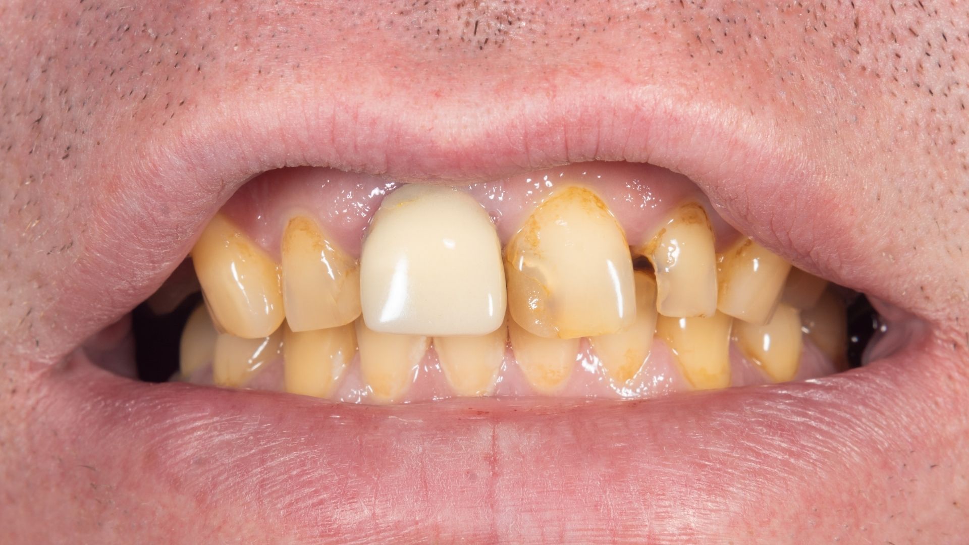 Porcelain Veneers - Nha Khoa 3C