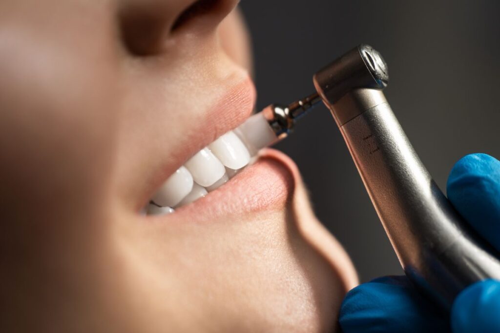 Porcelain Veneers - Nha Khoa 3C