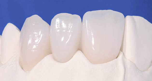 Porcelain Veneers - Nha Khoa 3C