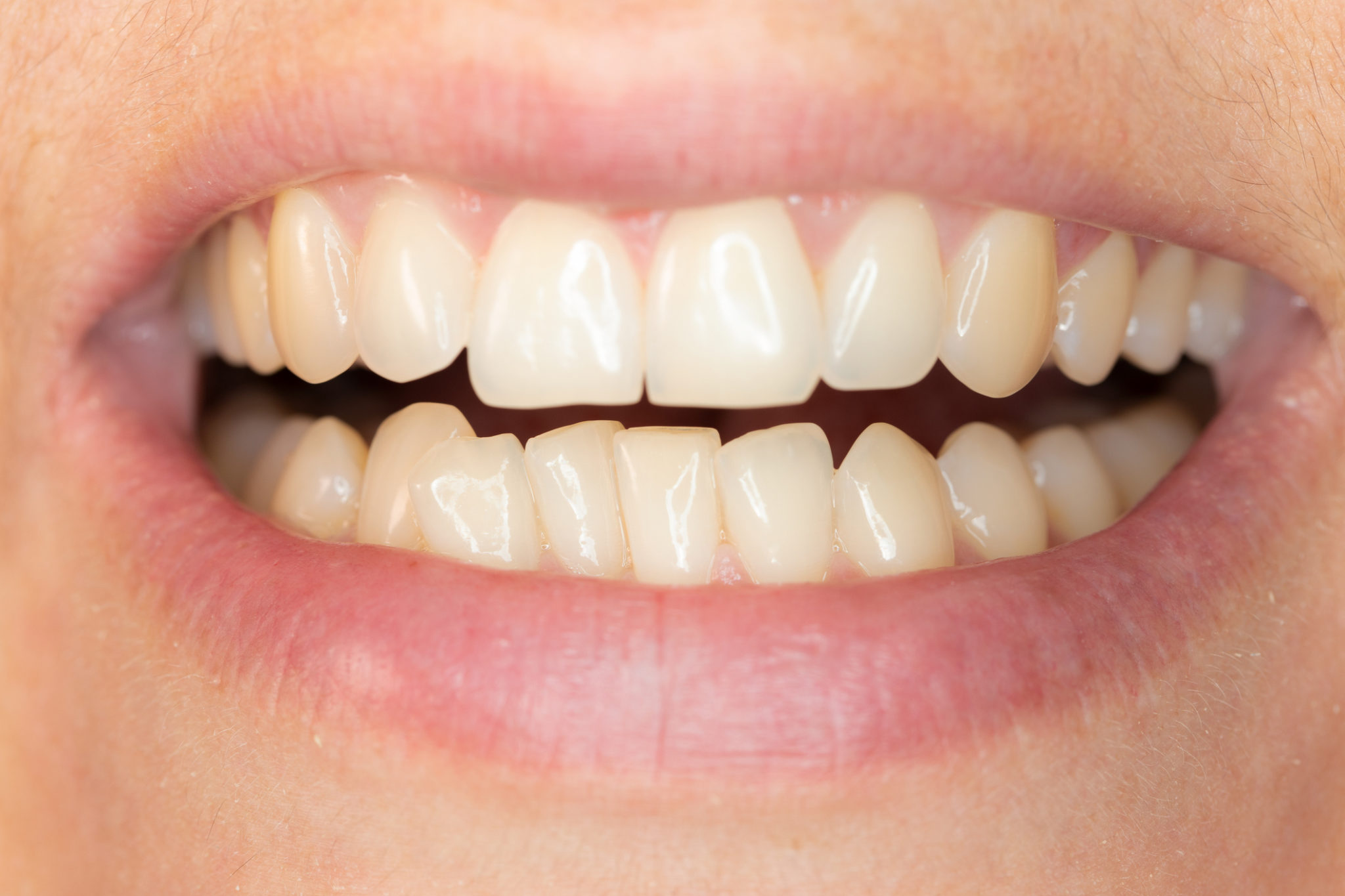 Porcelain Veneers - Nha Khoa 3C
