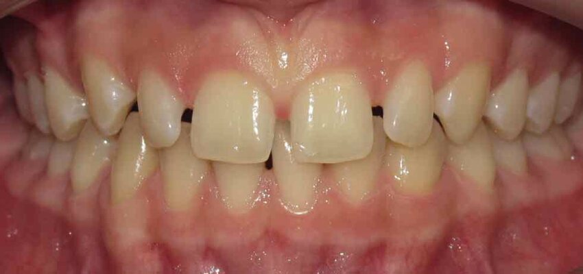 Porcelain Veneers - Nha Khoa 3C