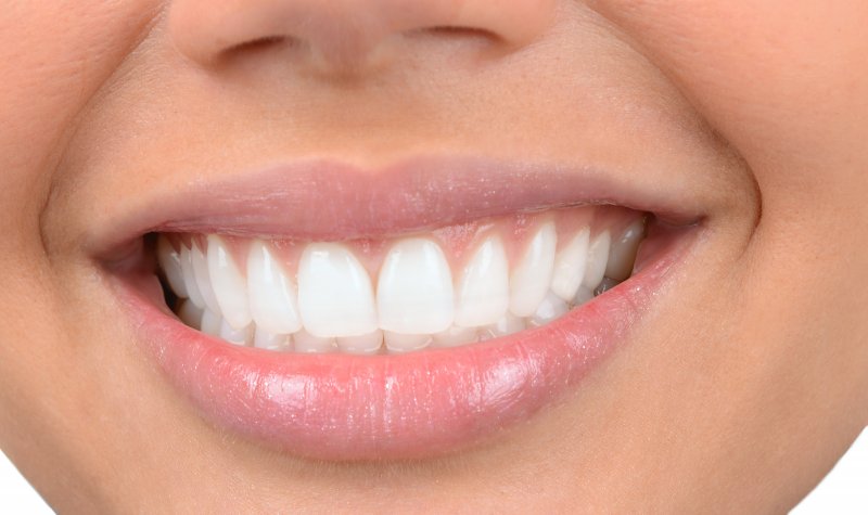 Porcelain Veneers - Nha Khoa 3C