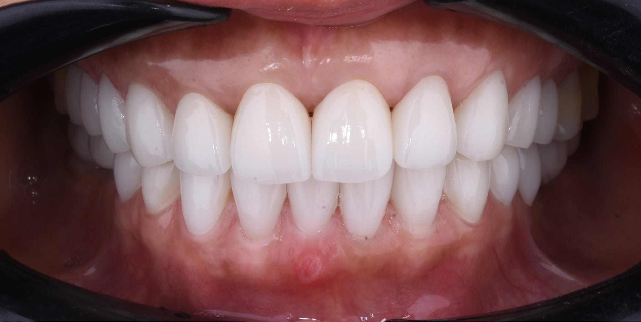 Porcelain Crowns - Nha Khoa 3C