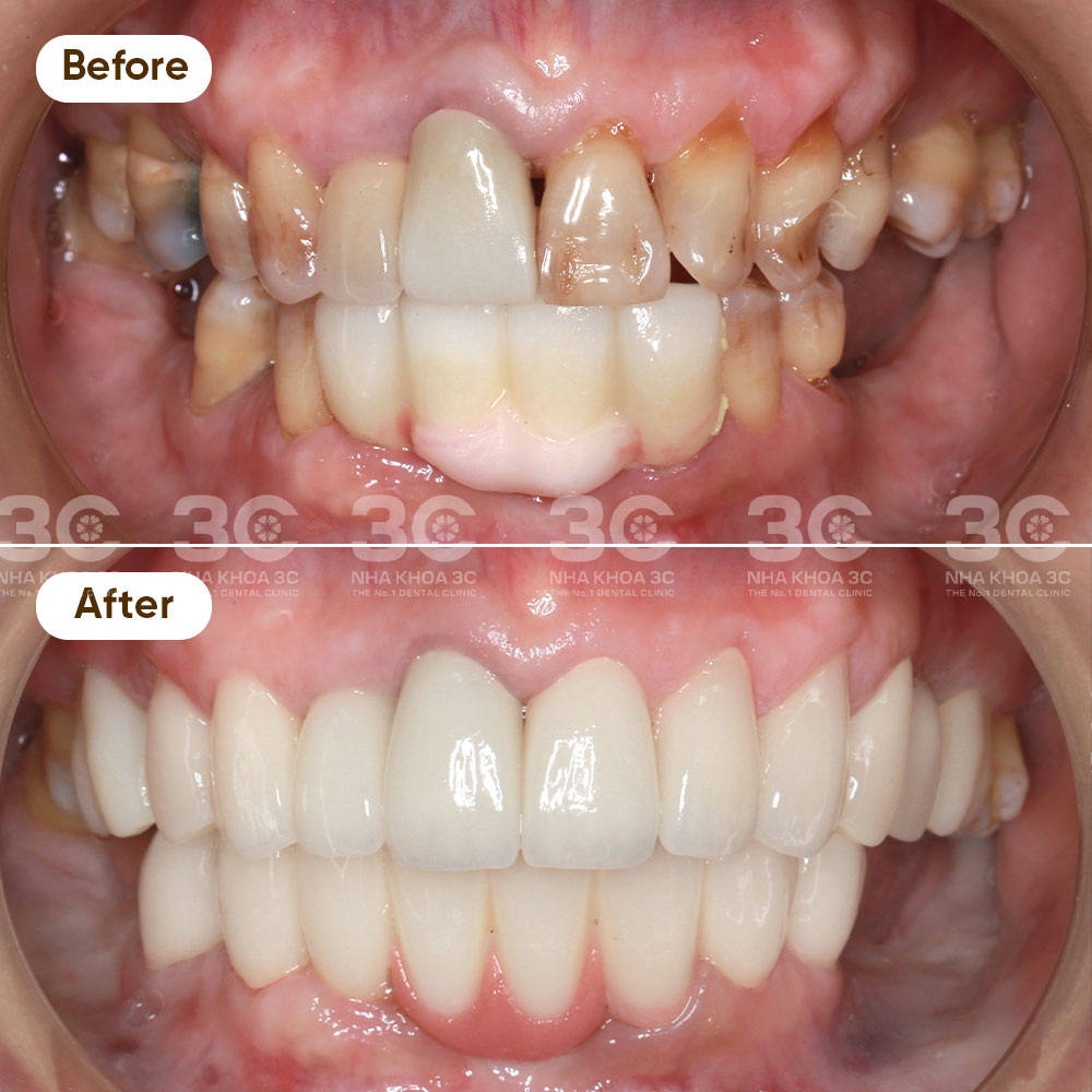 Porcelain Crowns - Nha Khoa 3C