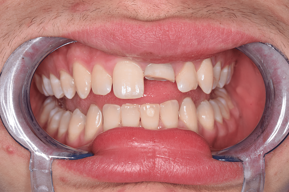 Porcelain Crowns - Nha Khoa 3C