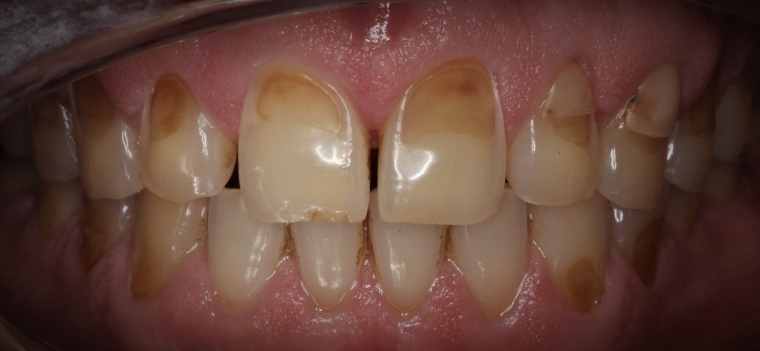 Porcelain Crowns - Nha Khoa 3C
