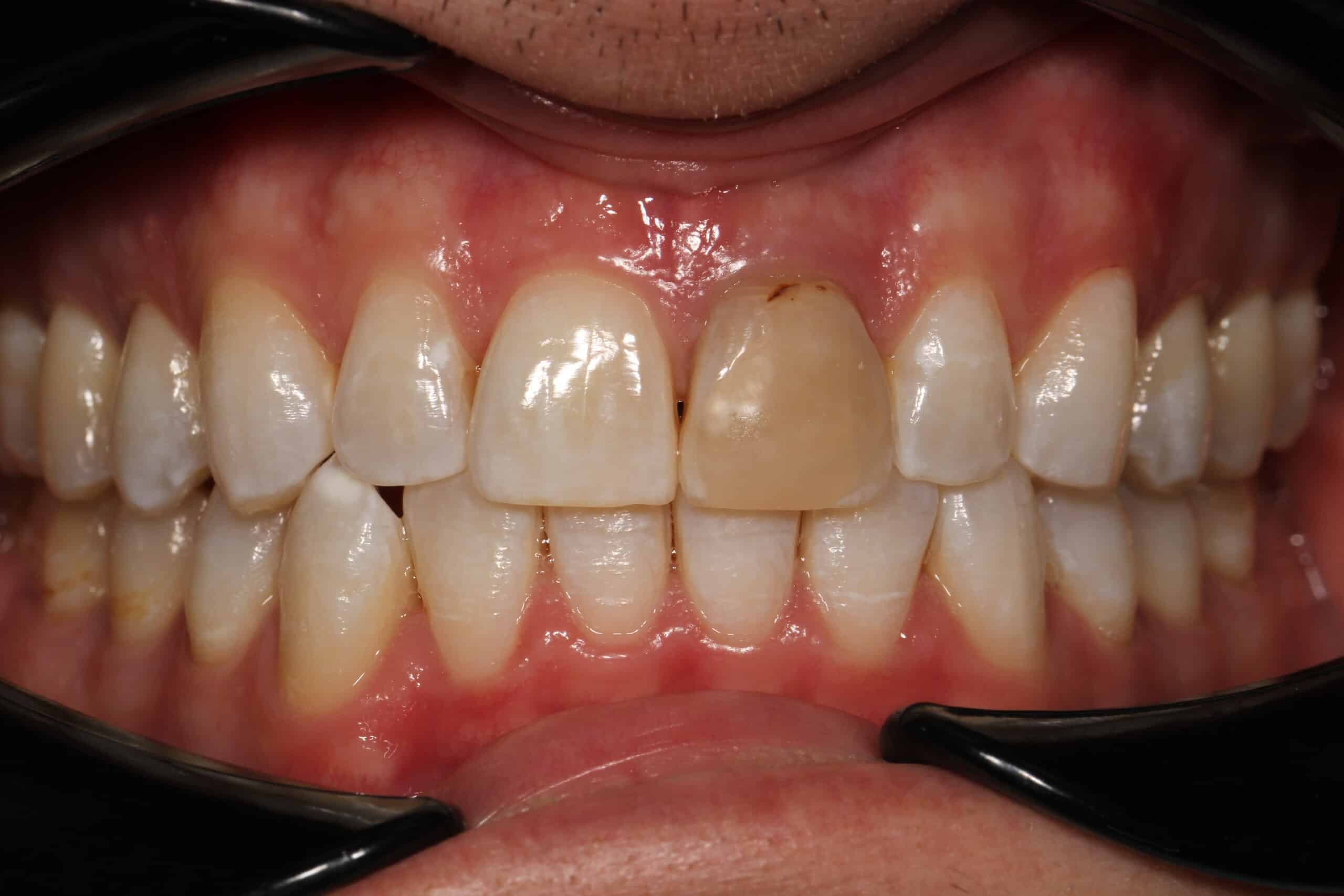 Porcelain Crowns - Nha Khoa 3C