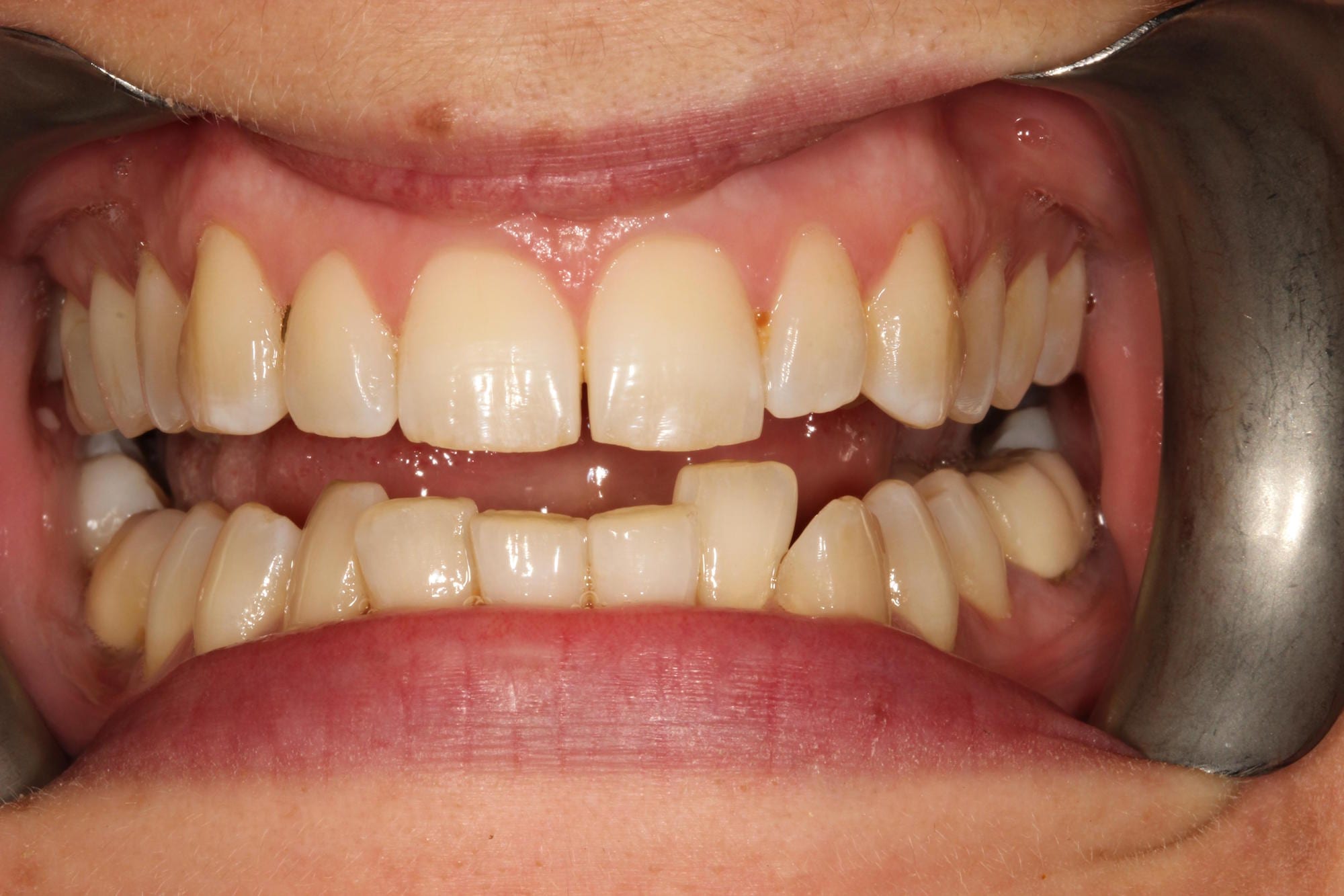 Porcelain Crowns - Nha Khoa 3C