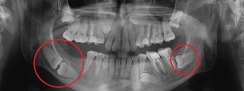 Wisdom Tooth Extraction - Nha Khoa 3C