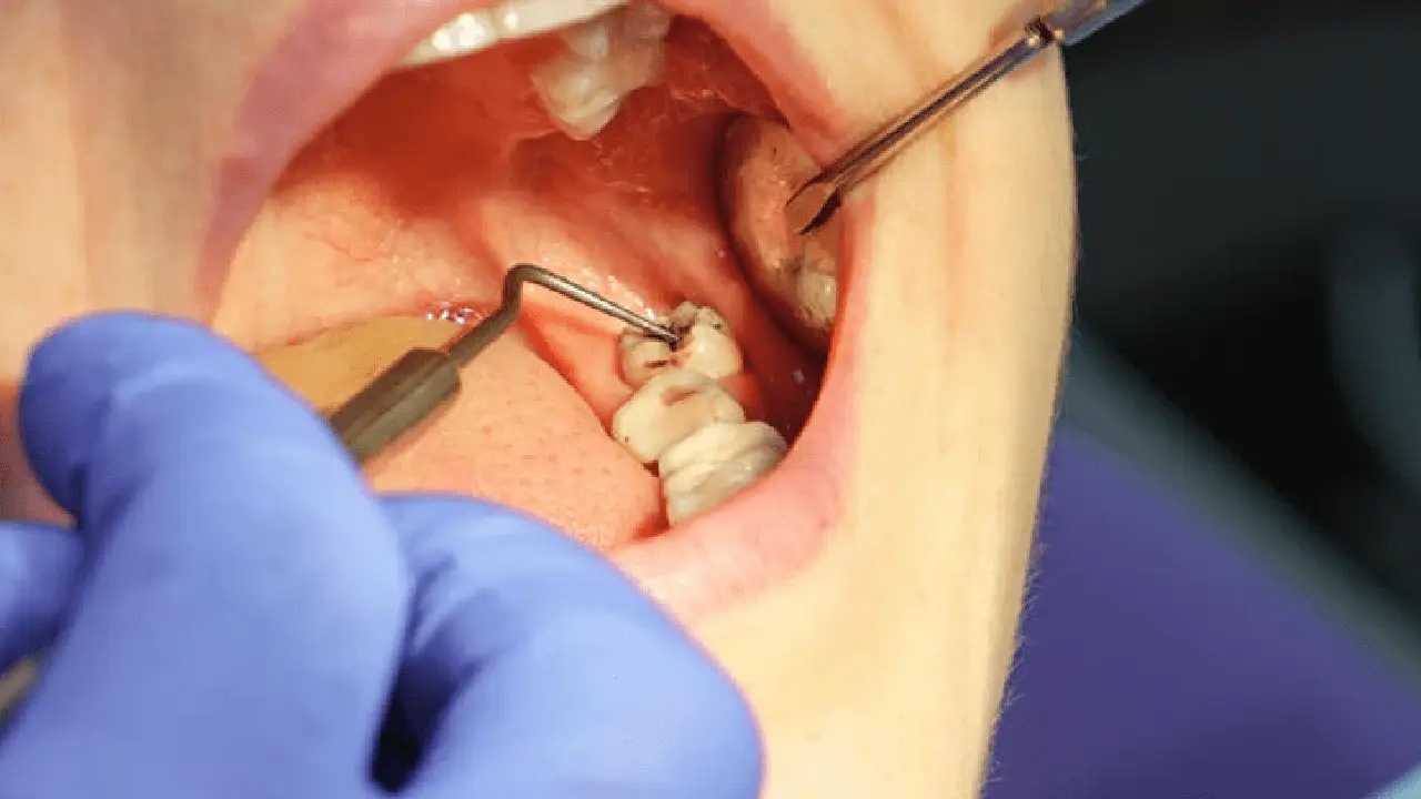 Wisdom Tooth Extraction - Nha Khoa 3C