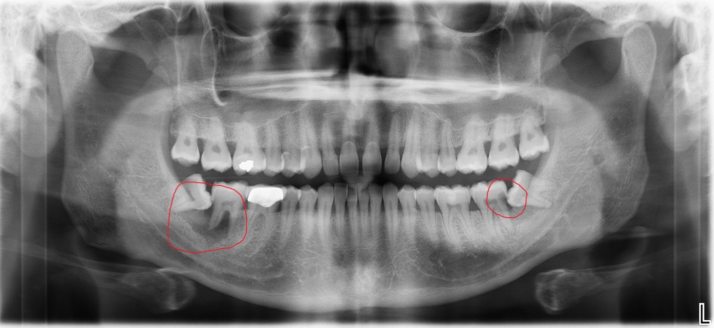 Wisdom Tooth Extraction - Nha Khoa 3C