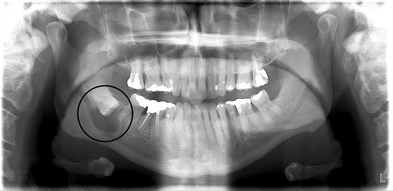 Wisdom Tooth Extraction - Nha Khoa 3C