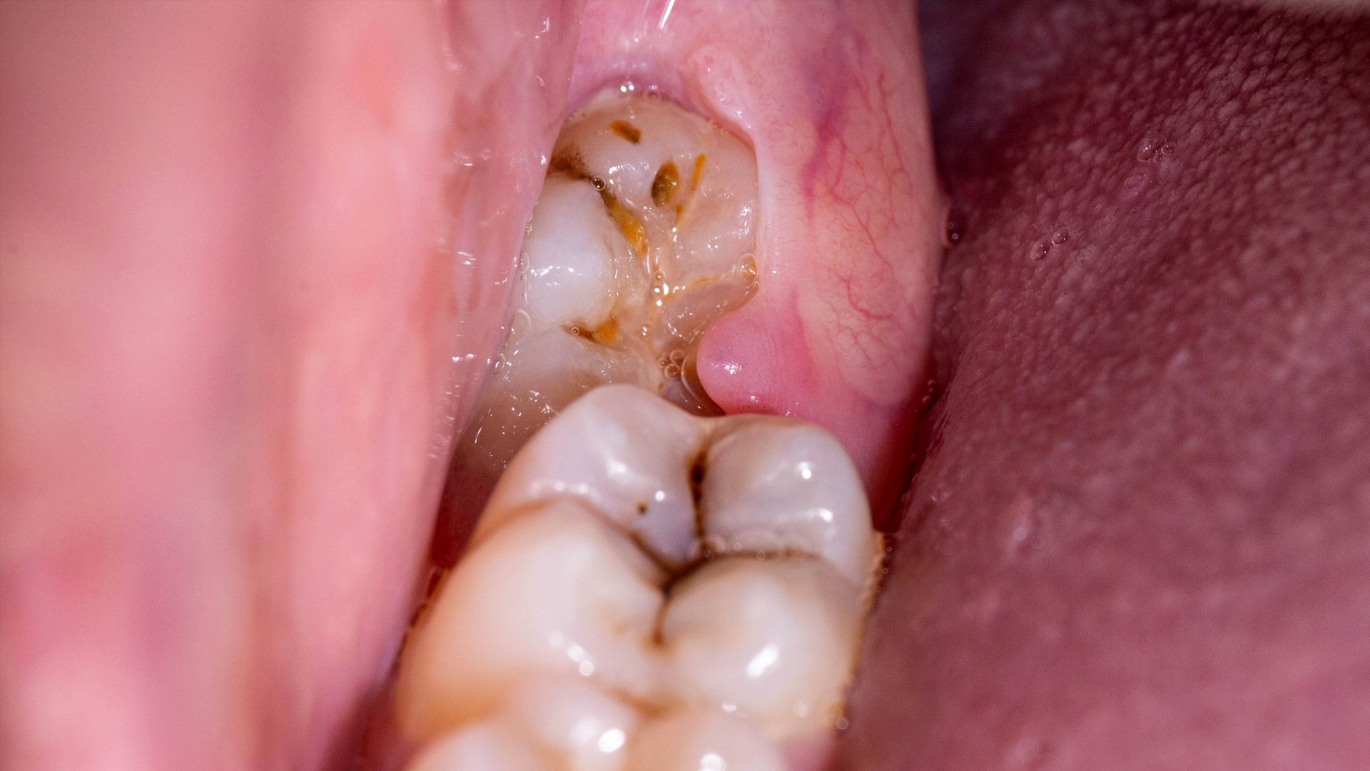 Wisdom Tooth Extraction - Nha Khoa 3C