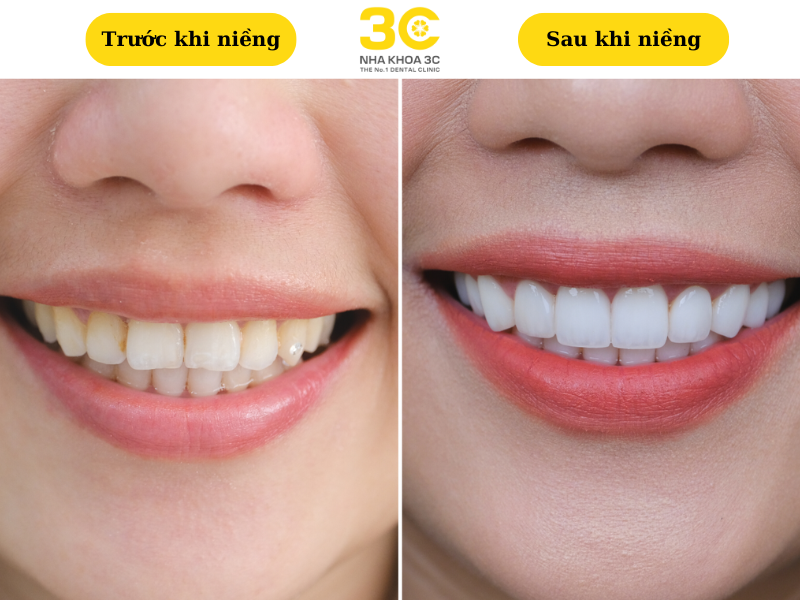 Kết quả hiệu chỉnh rõ rệt sau khi niềng răng trong suốt