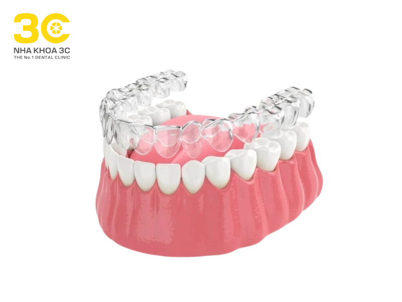 Khay niềng Clear Aligner sản xuất theo công nghệ của Đức