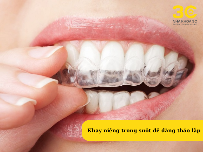 Khay niềng răng có thể tháo láp dễ dàng giúp ăn uống dễ dàng
