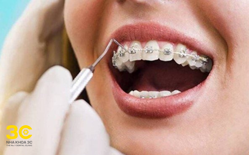 Kiến thức Nha khoa - Nha Khoa 3C