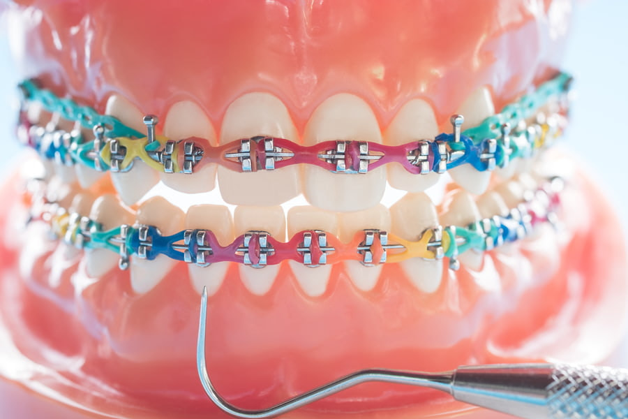 Cắm vít niềng răng là gì ? Có đau nguy hiểm không ?