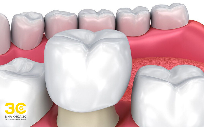 Bọc răng sứ là cách chỉnh răng mọc lệch không cần niềng được nhiều người lựa chọn