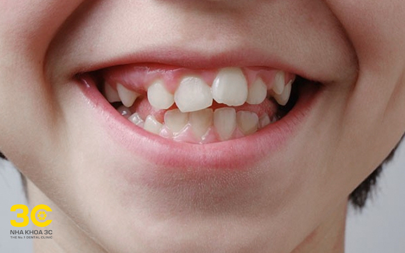 Răng mọc lệch ảnh hưởng không nhỏ đến thẩm mỹ cũng như sức khỏe răng miệng