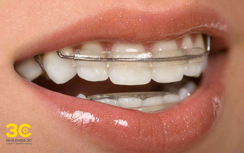 Thời gian đeo hàm duy trì trung bình bao lâu?