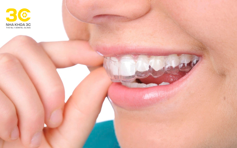 Hiện nay trên thị trường bán rất nhiều khay niềng răng tại nhà nhưng không đảm bảo được an toàn và tiêu chuẩn y tế