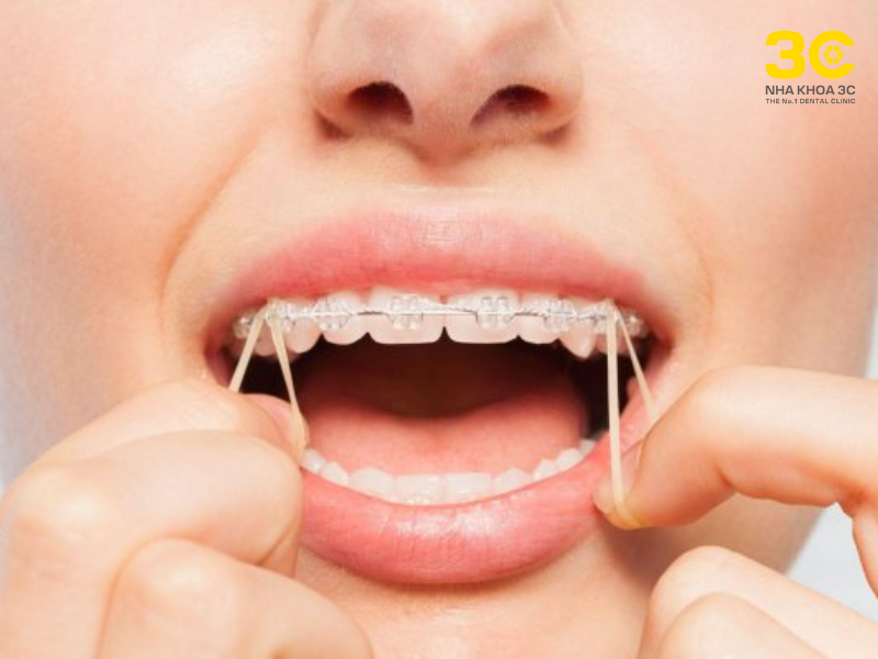 Dây thun liên hàm Cân chỉnh độ lệch giữa 2 hàm
