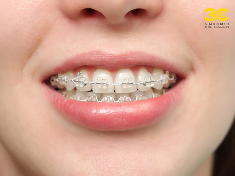 Khí cụ niềng răng (hay còn gọi là khí cụ chỉnh nha)