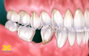 Mất răng số 6 niềng được không?