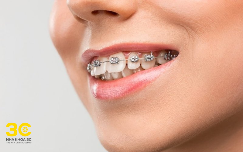 Răng hô, vẩu nặng được chỉ định cắm vít niềng răng