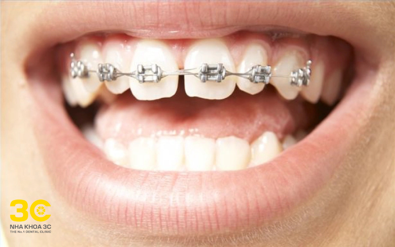 Răng thưa có niềng được không?