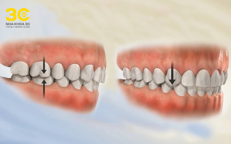 Sử dụng dụng cụ niềng răng tại nhà không đúng cách sẽ gây lệch khớp cắn