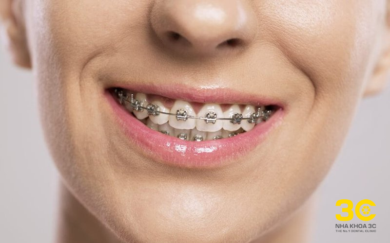 Niềng răng tại nhà có thật sự an toàn?