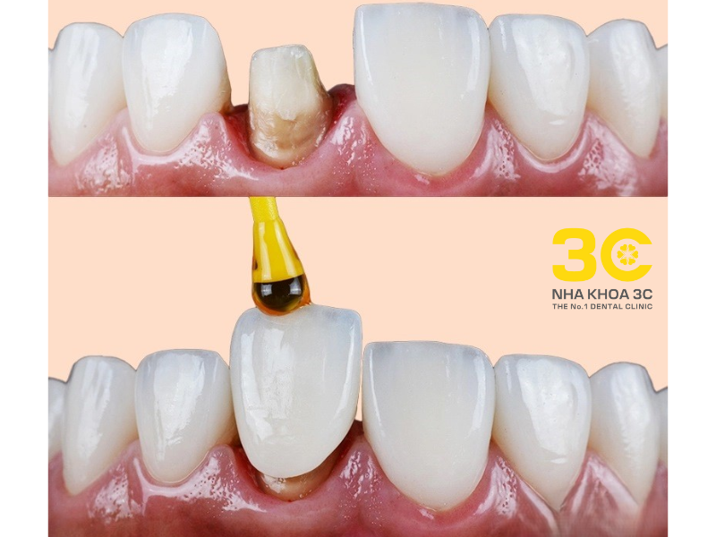 Bọc răng sứ cải thiện thẩm mỹ răng