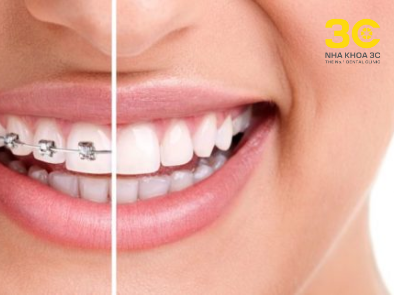 Bọc răng có sứ niềng răng được không?