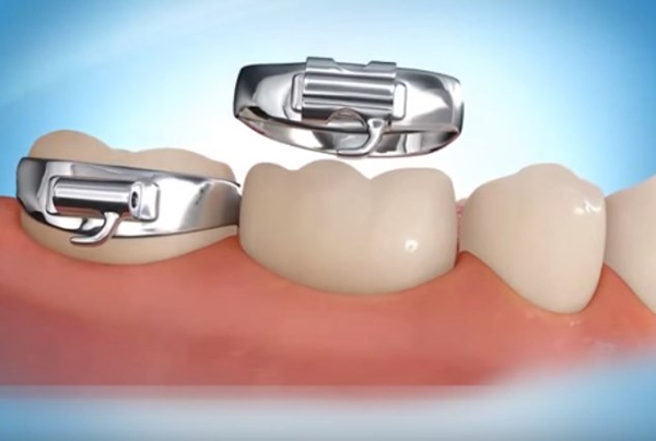 Khâu niềng răng được làm từ thép không rỉ