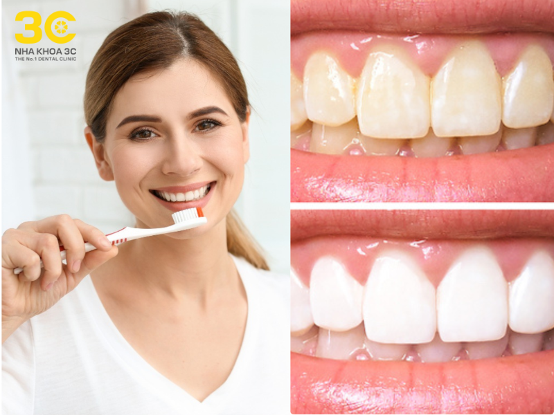 Kem tẩy trắng răng là sản phẩm được thiết kế để làm sáng màu răng, giúp loại bỏ các vết ố vàng và xỉn màu