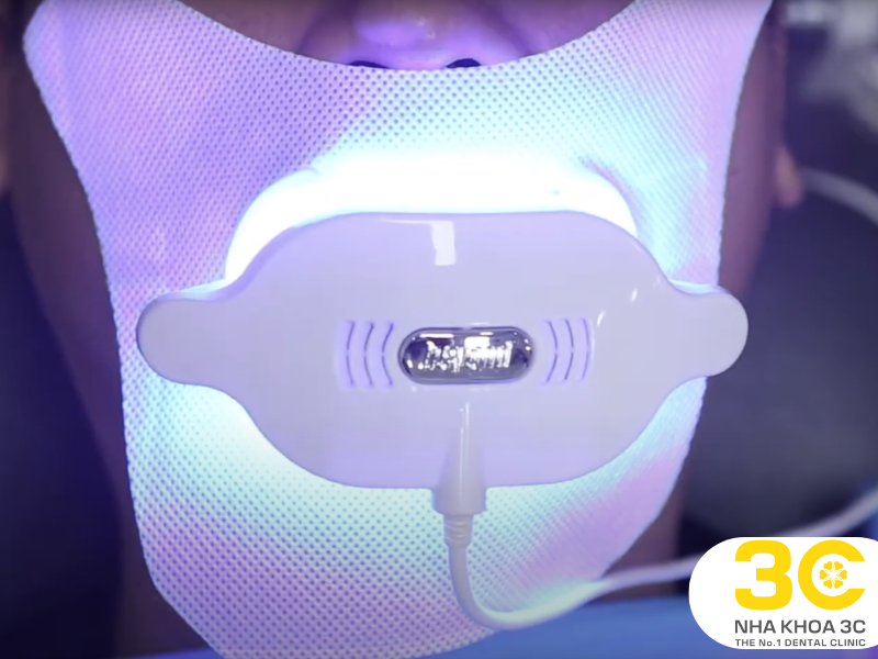 Tẩy trắng răng bằng công nghệ Beyond Whitening hiệu quả tức thì, bền đẹp lâu dài 
